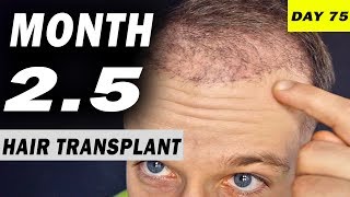 FUE Hair Transplant 25 MONTHS post op Istanbul Turkey [upl. by Lotz]