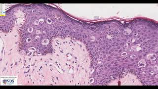 Breast Mammary Pagets disease Microscopy  Talking slide [upl. by Rehpretsirhc631]