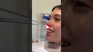 Rinoplastia  Retirando o Splint [upl. by Norred755]