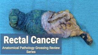 Rectal Cancer  Lymph Node Hunt  Anatomical Pathology Grossing Review Series [upl. by Asela]