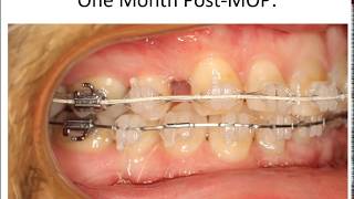 Orthodontic Treatment Accelerated Orthodontics May 23 2017 [upl. by Kimbra865]