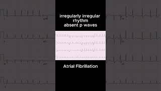 Atrial FibrillationCardiology ECG PMDC NLE NRE PLAB USMLE ecg ecgbasics education ecgtutorial [upl. by Dorweiler]