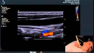 Hot Tips  Finding the Vertebral Artery with Ultrasound [upl. by Wolfgram22]