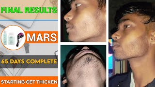 BEARD GROWTH  65 days complete  Starting get more thicken  2 months ✔️ from minoxidil [upl. by Suqram]