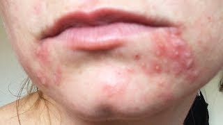 Dealing with Recurring Perioral Dermatitis [upl. by Parcel]