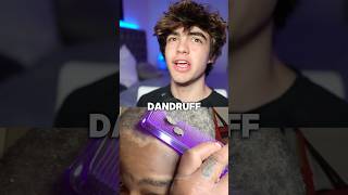 How to get rid of dandruff 😱🤝 [upl. by Arundel]