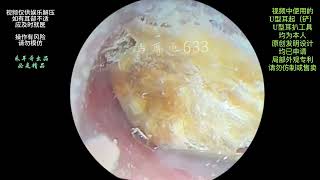 采耳哥The ear canal is blocked by large pieces of fungal earwax for cleaning [upl. by Tzong]