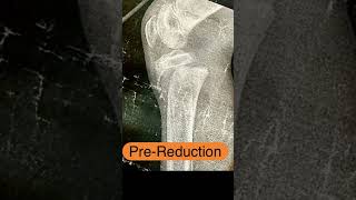 Close reduction of proximal epiphyseal slip of tibia in kids  SALTERHARRIS type 1 [upl. by Aenert]