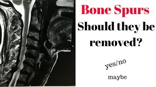 Bone spurs cause pain [upl. by Farrica777]