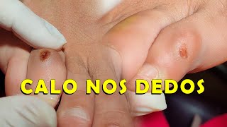 CALO NO DEDO DO PÉ  Vipé Podologia [upl. by Shirleen]