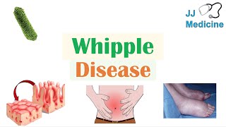 Whipple Disease  Causes Risk Factors Pathophysiology Symptoms Diagnosis Treatment [upl. by Maxia]