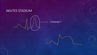 EKG Crashkurs Teil 5 Herzinfarkt [upl. by Fowkes]