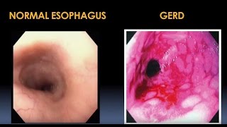 Diagnosis and Treatment for Esophageal and Motility Disorders Video  Brigham and Womens Hospital [upl. by Kristoffer]