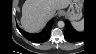 Urothelial neoplasm [upl. by Ociral]