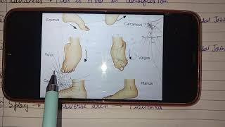 CTEV part1 Congenital Talipes Equino varus Club foot [upl. by Algy]