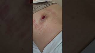 Cisto infectado que estourou Infected cyst that burst [upl. by Derry]