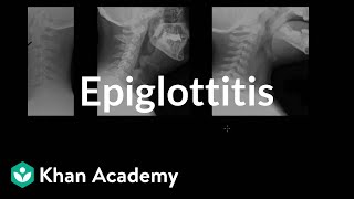 Epiglottitis diagnosis and treatment  Respiratory system diseases  NCLEXRN  Khan Academy [upl. by Seys569]