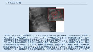 ショイエルマン病 [upl. by Charmion]