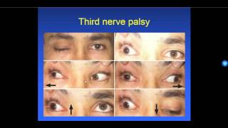 Diplopia 26  Types of Strabismus [upl. by Aset]