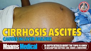 Ascites Fluid Buildup Causes Symptoms and Treatment  Maams [upl. by Suter]