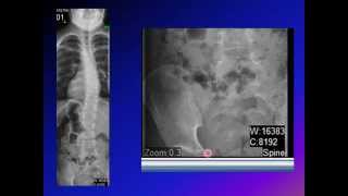 Cobb angle Scoliosis angle [upl. by Assetak]