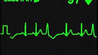 Ventricular Trigeminy  ECG SImulator  Arrhythmia Simulator [upl. by Gnim]