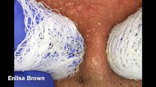 Filament Ingrown Hair and Blackheads Short and Sweet Video of Daryl [upl. by Giliana1]