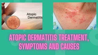 Atopic dermatitis treatment symptoms and causes  Nuse Healthy [upl. by Ainevul]