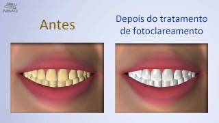 Clareamento a LED MM Optics [upl. by Ragen195]