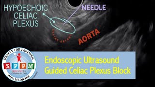 Endoscopic Ultrasound Guided Celiac Plexus Block for Pediatric Chronic Abdominal Pain [upl. by Janaya260]