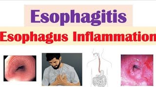 Esophagitis [upl. by Kallman448]