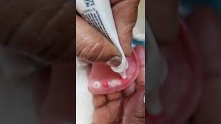 Applying Denture Creme Adhesive [upl. by Nedaj]