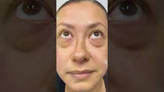 Blefaroplastia inferior con transposición de grasa orbitaria  Arte Facial [upl. by Enneirdna]