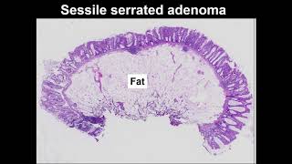 Serrated polyps Learn to tell the difference between hyperplastic polyp and sessile serrated lesion [upl. by Katrina]