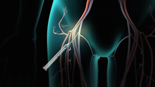 Catheter Ablation [upl. by Rabbi821]