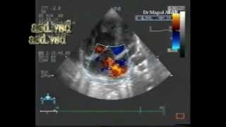 combined shuntslarge subaortic vsdlarge ostium secundum asd and multiple small apical vsds [upl. by Fretwell]