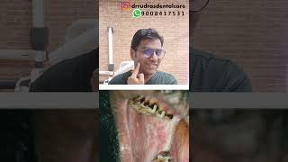 Dr Rudra Mohan Oral Sub Mucous FibrosisOSMFdrrudrasdentalcare drrudramohan osmf osmftreatment [upl. by Cressy]