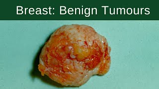 Breast Benign Tumours  Pathology mini tutorial [upl. by Aniroz]