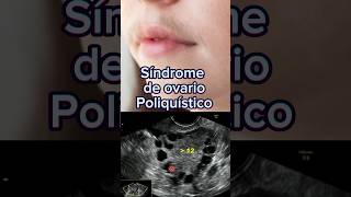 ¡Alerta Síndrome de ovario poliquístico  Dr William Guerrero medicina shorts [upl. by Marcel307]