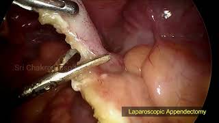 Laparoscopic Appendectomy  With In 6 Minutes  Step By Step  Day 75100 [upl. by Myrtie547]