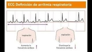 Arritmia sinusal respiratoria [upl. by Einahpet]