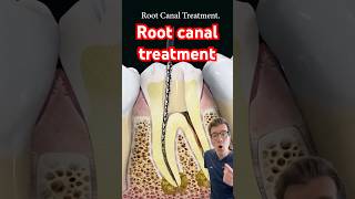 Doctor explains Root Canal treatment shorts dental [upl. by Tolliver721]