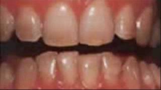 Dental Bleeching  White Teeth  beautiful results in Belgium [upl. by Anonyw764]