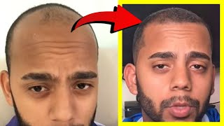 Crazy Minoxidil 5 Hair Growth in 25 Months Fails after 25 YEARS Heres WHY [upl. by Ardnosal232]