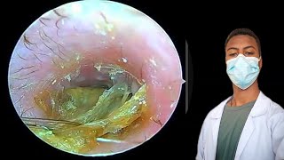 Satisfying Ear Wax Extraction You Won’t Believe Thisearearwaxearwaxremovalearwaxcleaningrelax [upl. by Pearle640]