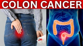 Colon Cancer Early Warning Signs and Symptoms You Shouldnt Ignore [upl. by Paloma665]