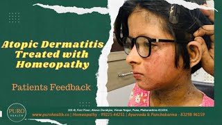 Homeopathy cures Atopic Dermatitis permanently  होम्योपैथीसे एटोपिक डर्मेटिटिस ठीक हुआ [upl. by Annavoj]