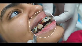 Correcting a BlockedOut Lateral Incisor Treatment Options and Solutions orthodontics [upl. by Tiffanle]