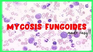 Mycosis Fungoides  WBC disorders  Sezary Syndrome [upl. by Bordie]