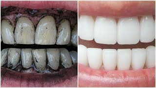 3 Way to Whiten Your Yellow Teeth Naturally [upl. by Faline342]